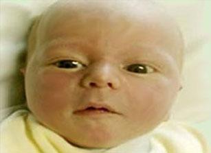 Seguimiento de neonatos con hiperbilirrubinemia severa