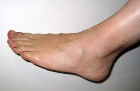 Úlceras del pie por diabetes