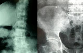 El cuidado de la salud ósea es fundamental para prevenir la osteoporosis