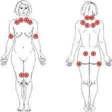 ¿Es hereditaria la fibromialgia?