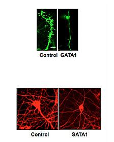 Estrés y depresión pueden encoger el cerebro