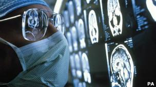 Estrés y depresión pueden encoger el cerebro