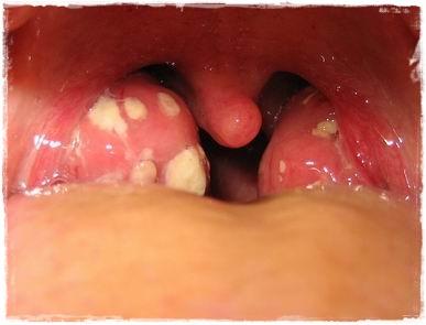 La faringoamigdalitis aguda en los niños