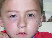 Expertos relacionan infecciones virales riesgo asma niños