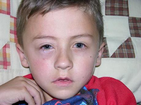 Expertos relacionan infecciones virales con riesgo de asma en los niños