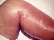 celulitis bacteriana