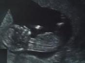 Síndrome Grey-Steele