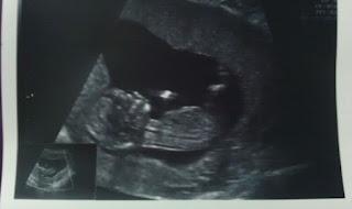 El Síndrome Grey-Steele