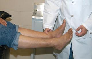 Pie diabético, complicación por mal control de glucosa, falta de higiene y deformación en extremidades