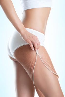 REMEDIOS NATURALES PARA ELIMINAR LA CELULITIS