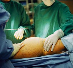 La liposucción puede causar la formación de grasa visceral