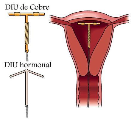 El DIU es más eficaz que la píldora para prevenir el embarazo