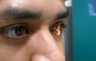 Tiene IMSS alta capacidad para solucionar problemas por cataratas