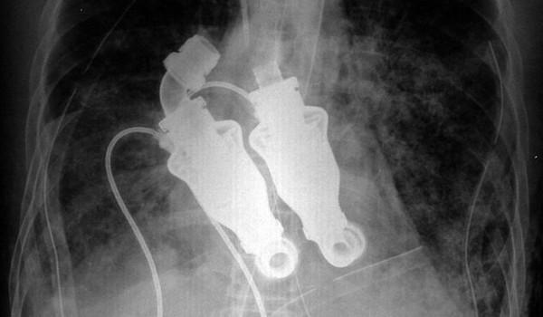 Bombas del corazon artificial