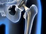 halla enlace temprano entre implantes cadera metálicos desarrollo cáncer