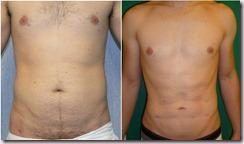 PRESUME DE CUERPO 10 SIN PISAR EL GIMNASIO Opcin Mdica antes y despus 1 thumb PRESUME DE CUERPO 10 SIN PISAR EL GIMNASIO