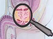 Cáncer próstata clave detectarlo tiempo