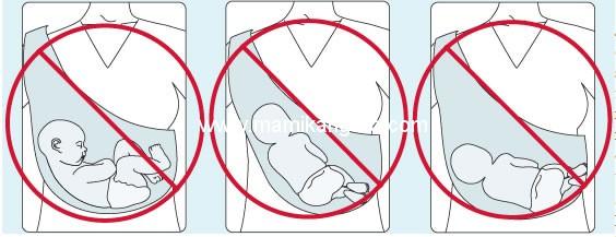 malasposiciones Semana Internacional de la Crianza en Brazos 2012: tenerte naturalmente protegido