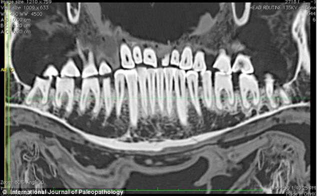 Encuentran momia egipcia de 2.100 años de antigüedad con empastes en los dientes.