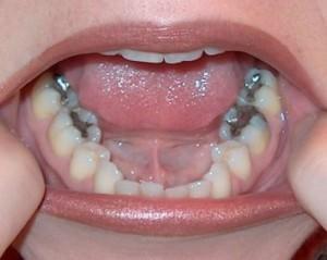 Las amalgamas dentales de mercurio no son tóxicas, según la Audiencia Nacional