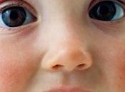 Alergias típicas bebés niños