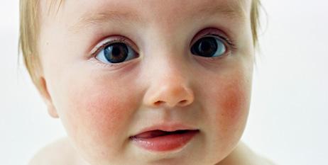 Alergias típicas en bebés y niños
