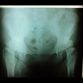 Glucosamina Condroitin para el dolor articular. Osteartrosis Glucosamina Condroitin para el dolor articular. Osteartrosis