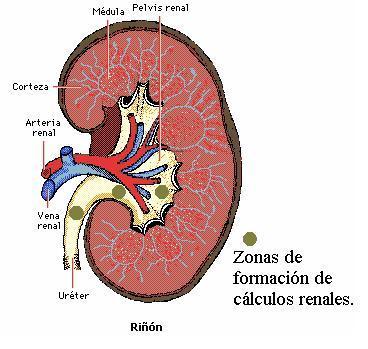 Prevención de la reaparición de la litiasis renal