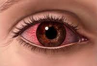 conjuntivitis