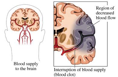 Tratamiento y tipos de apraxia