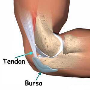 Los diferentes tipos de bursitis que afectan nuestra salud