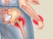 fracturas frecuentes asociadas Osteoporosis