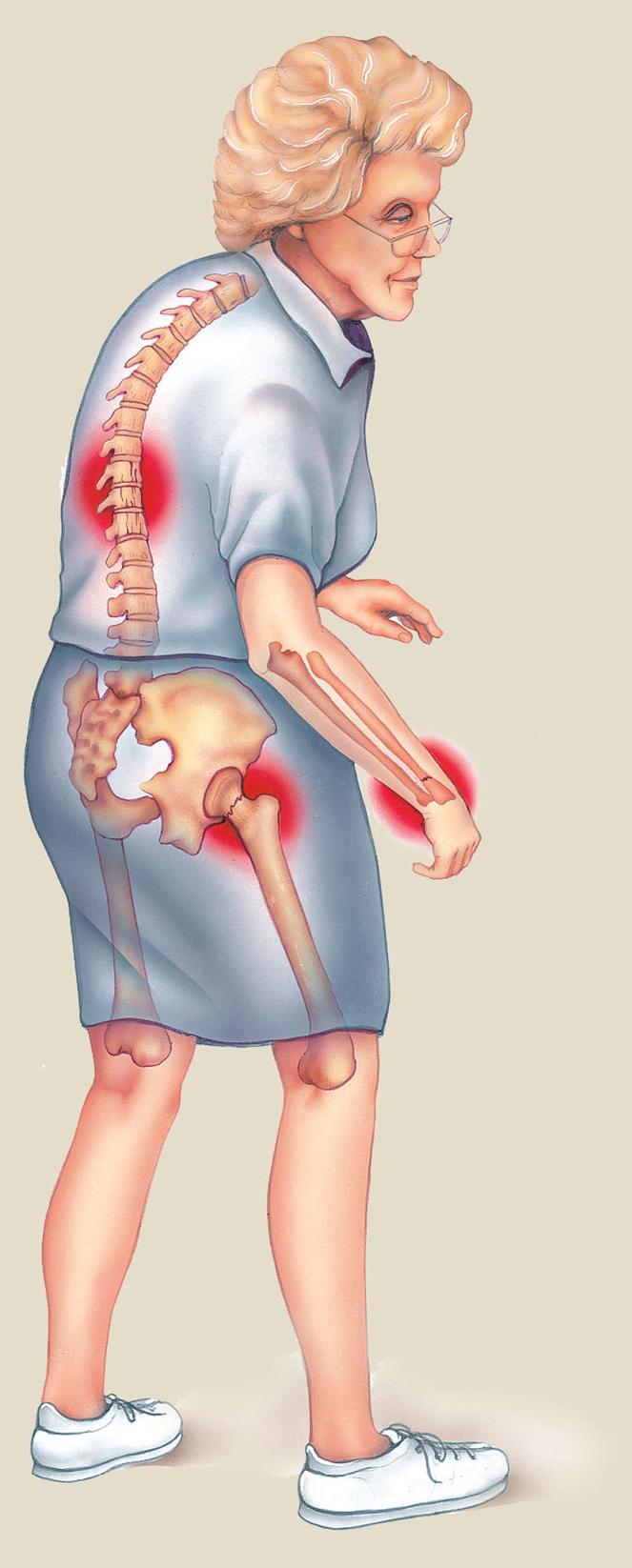 Las fracturas más frecuentes asociadas a la Osteoporosis