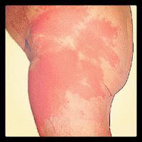 Erisipela, Infección de la Piel Erisipela, Infección de la Piel