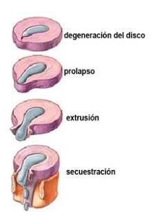 ¿Qué es una extrusión de disco en una Hernia Discal?