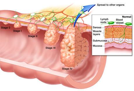 La leche protegería la progresión del cáncer de colon
