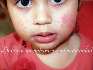 Virus mano-pie-boca o boca-mano-pie