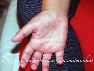 Virus mano-pie-boca o boca-mano-pie