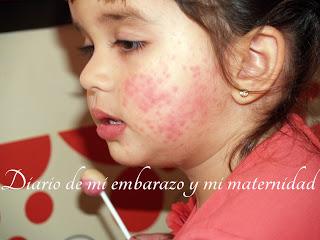 Virus mano-pie-boca o boca-mano-pie