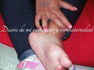 Virus mano-pie-boca o boca-mano-pie