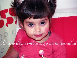 Virus mano-pie-boca o boca-mano-pie