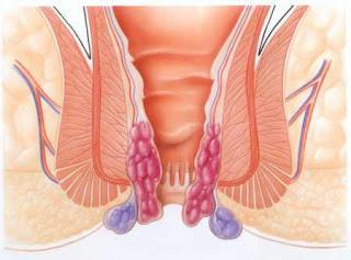 ¿Qué es una Hemorroide?