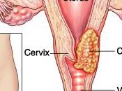 comunidades escasos recursos enfrentan mayor riesgo cáncer cervical