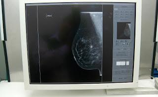 Cuenta PrevenIMSS con tres estrategias para diagnosticar el cáncer de mama de manera oportuna