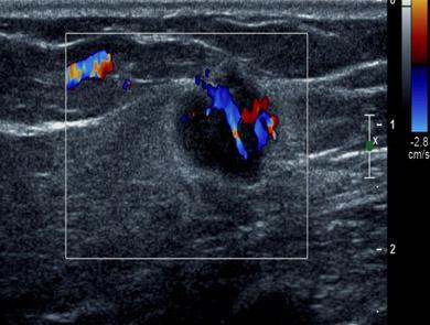 Tratamiento del Cáncer de Mama con Ultrasonido