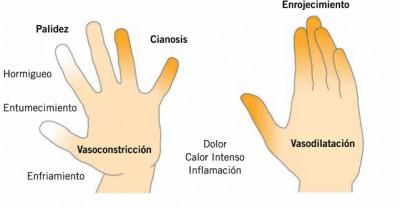 Sabañones, causas y remedios