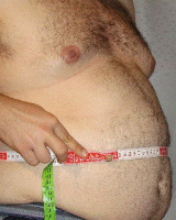 Ictus y Obesidad Ictus y Obesidad