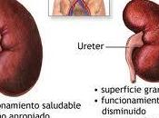 Trasplante riñón, mejor opción