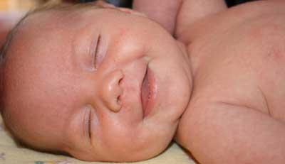 El 20% de bebés tienen dermatitis atópica y más riesgo de desarrollar alergia al látex