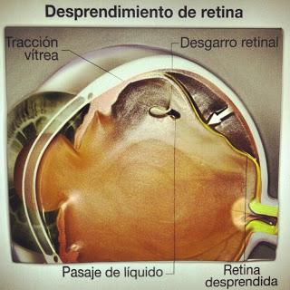 El Desprendimiento de Retina